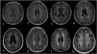 Identification of White Matter Lesions in Patients With Acute Ischemic Lesions Using U-net